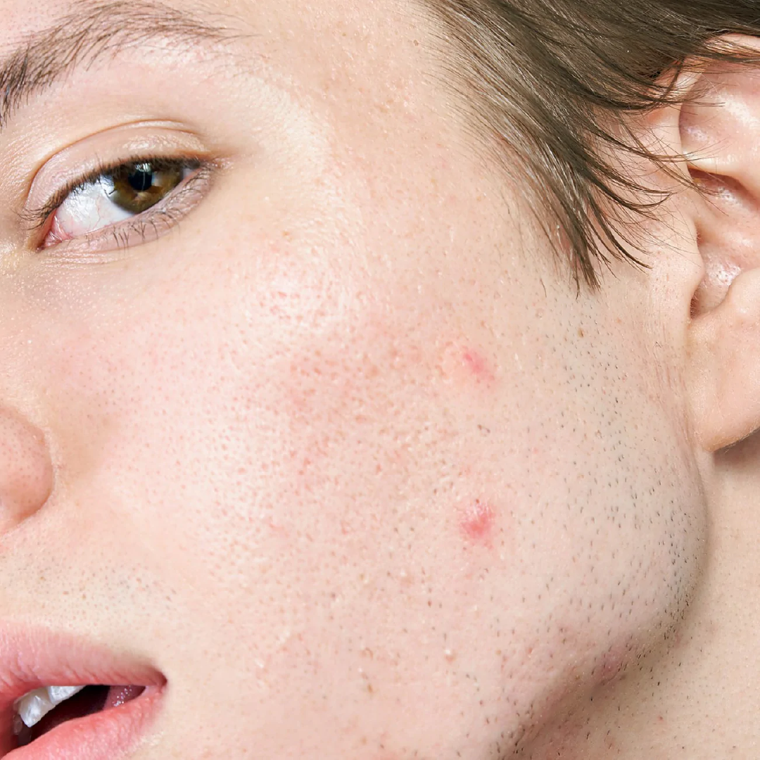 Micropoint for Blemishes