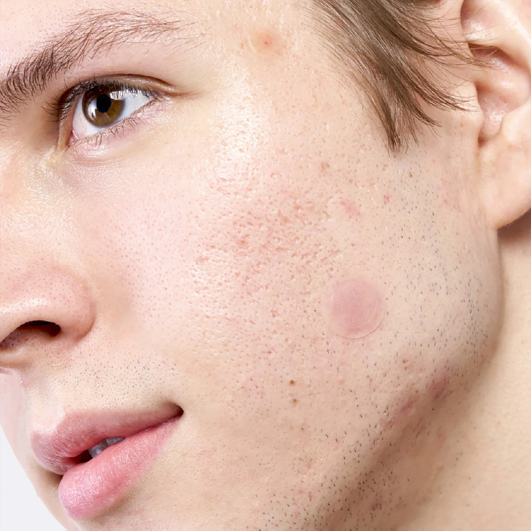 Micropoint for Blemishes